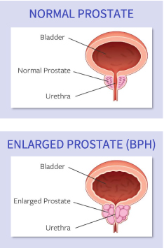 Graphic showing a normal prostate and an enlarged prostate